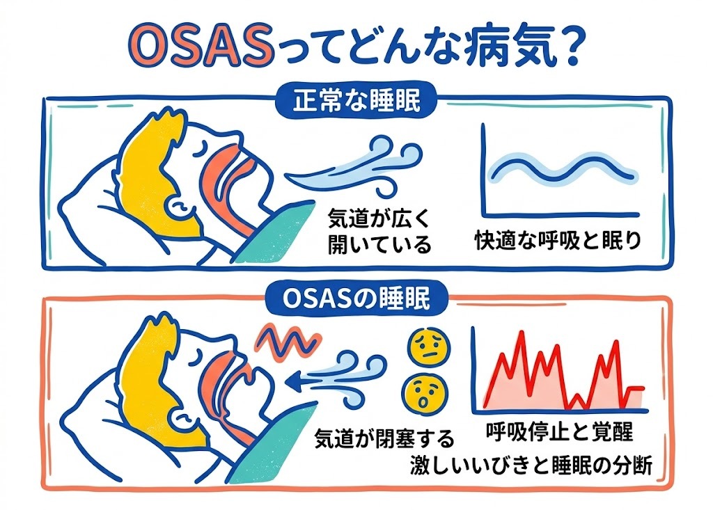 OSAS